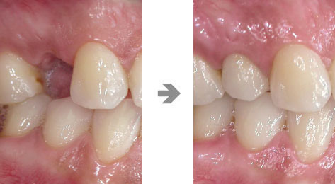 インプラント症例1